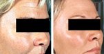 Laser Paris pour les taches brunes du visage par Dr Modiano