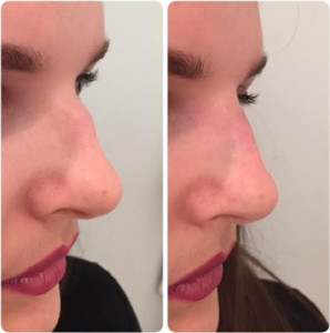 Rhinoplastie médicale.jpg