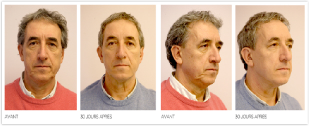 Retendre l'ovale du visage sans chirurgie à Paris, photo avant après